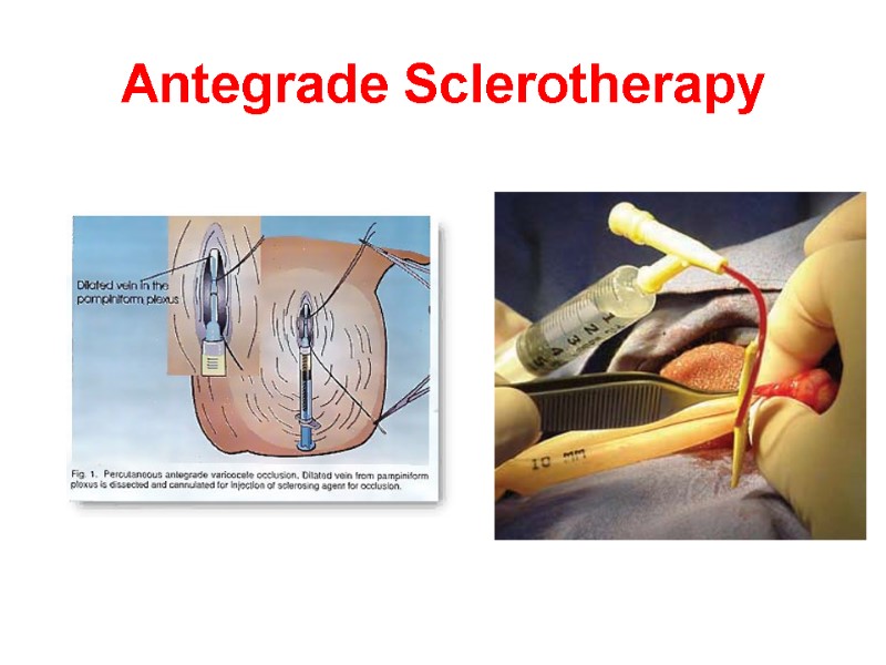 Antegrade Sclerotherapy